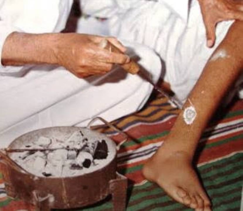 الطب الشعبي بـ "الكي": حكمة الألم والشفاء في الموروث اليمني